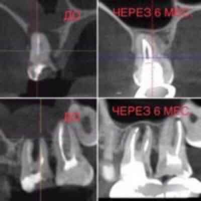 Успешное лечение кисты корня зуба