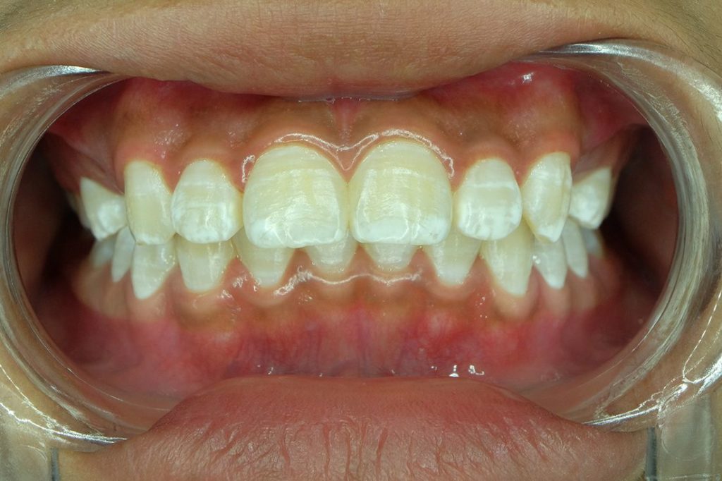 Изменение цвета и структуры зуба из-за флюороза