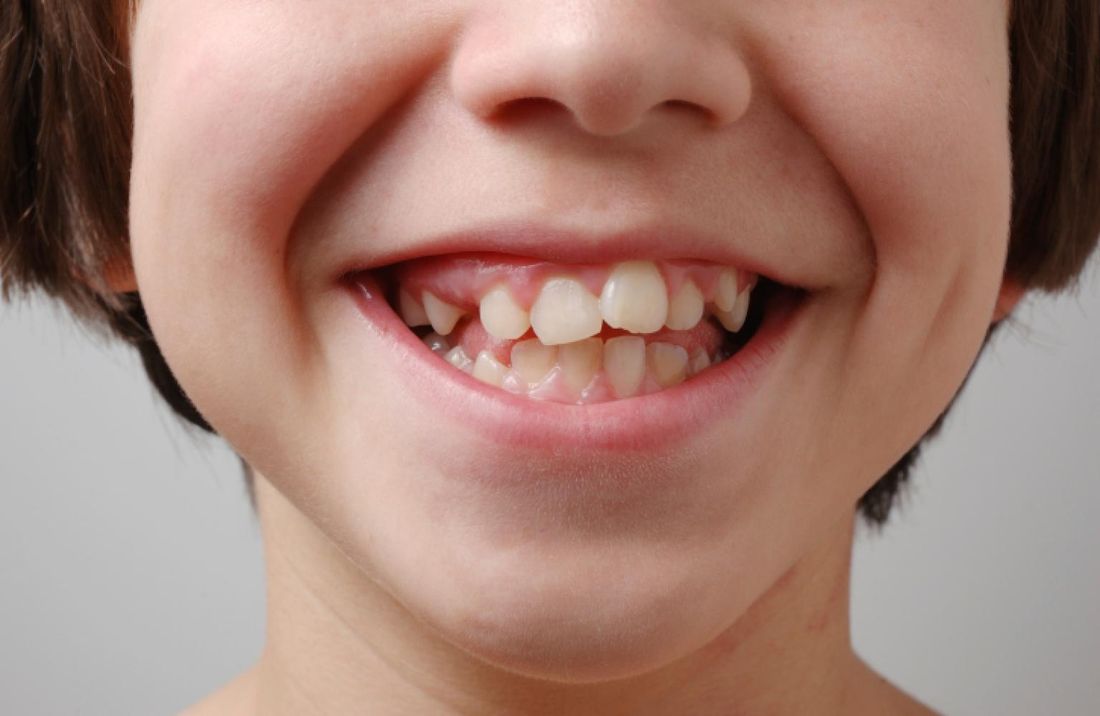 передние зубы у детей фото